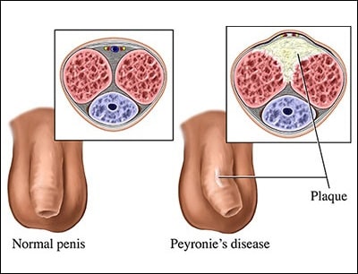 Peyronie's Disease