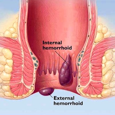 Hemorrhoids images - piles images