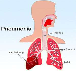 Pneumonia