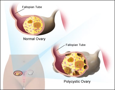 Polycystic Ovarian Disease