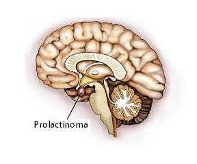 Prolactinoma