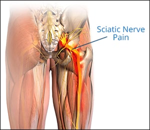 Sciatica