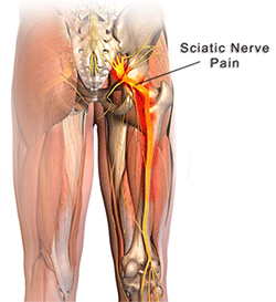 Sciatica