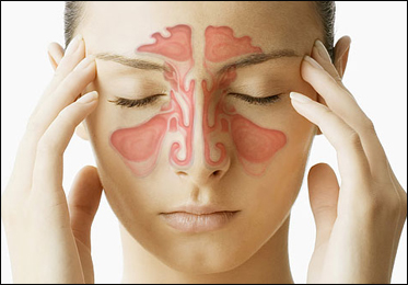 Sinusitis