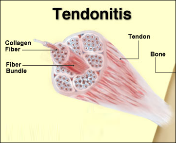 Tendonitis