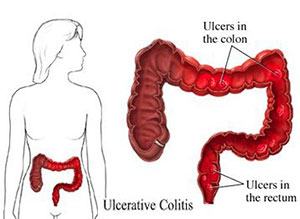 Ulcerative Colitis