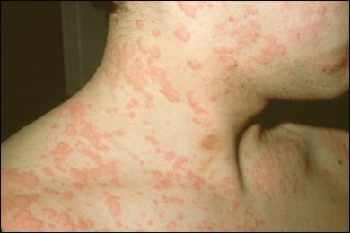 Urticaria