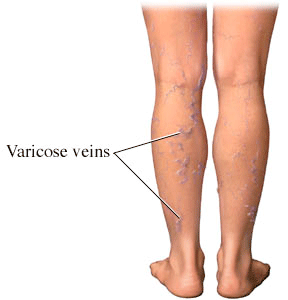 Varicose Veins 