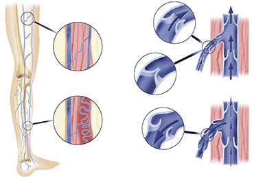 Varicose Veins