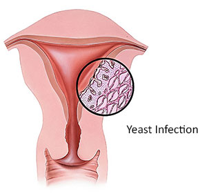 Yeast infection