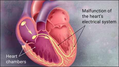 Abnormal Heart Rhythm