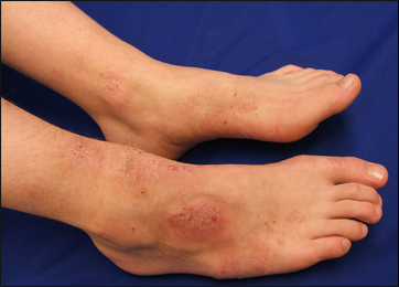 Atopic Dermatitis Atopic Dermatitis