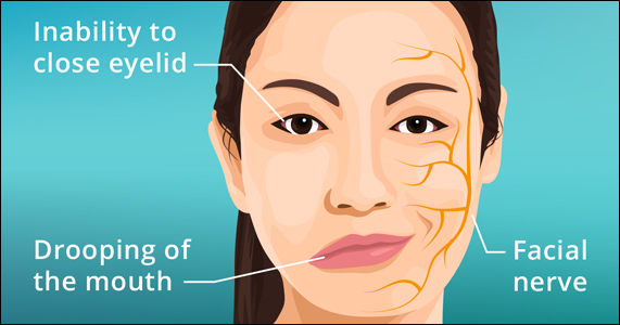 Bell's Palsy, Facial Paralysis