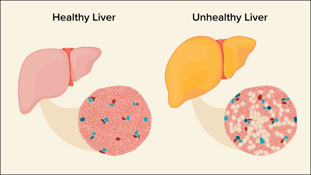 Fatty Liver