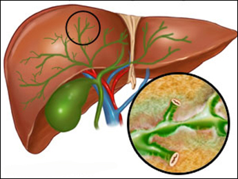 Primary Sclerosing Cholangitis