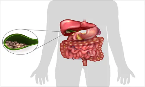 Gall Stones