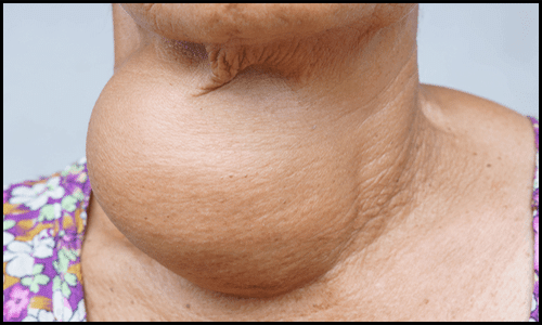 Hyperthyroidism