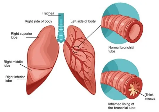 Ayurvedic Remedies for Allergic Bronchitis