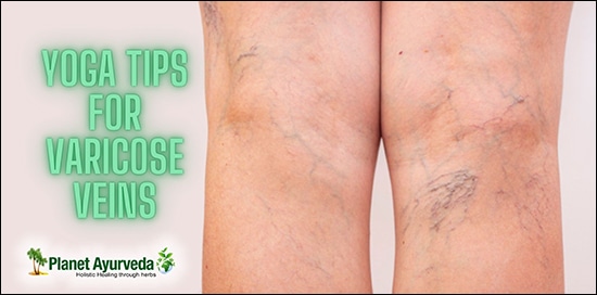 Varicose Veins