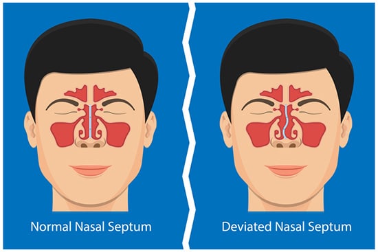 Deviated Nasal Septum