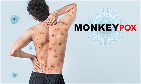 Monkeypox virus