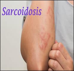 Sarcoidosis