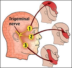 Trigeminal Neuralgia