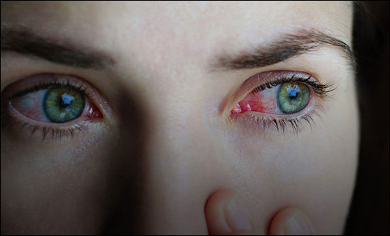 Conjunctivitis, Pink Eye, An Ayurvedic Perspective